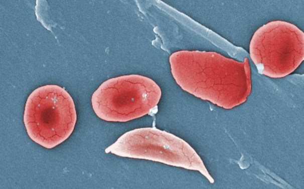 Bild på röda blodkroppar från en patient med sickelcellanemi.