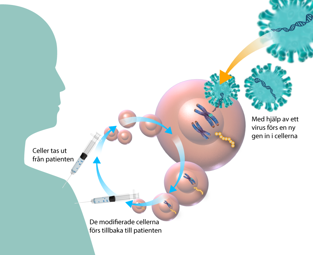 En illustration som visar de olika stegen vid en vanlig form av genterapi. Celler isoleras från en patient, modifieras på lab med en ny gen med hjälp av en virusvektor och återförs som behandling, 