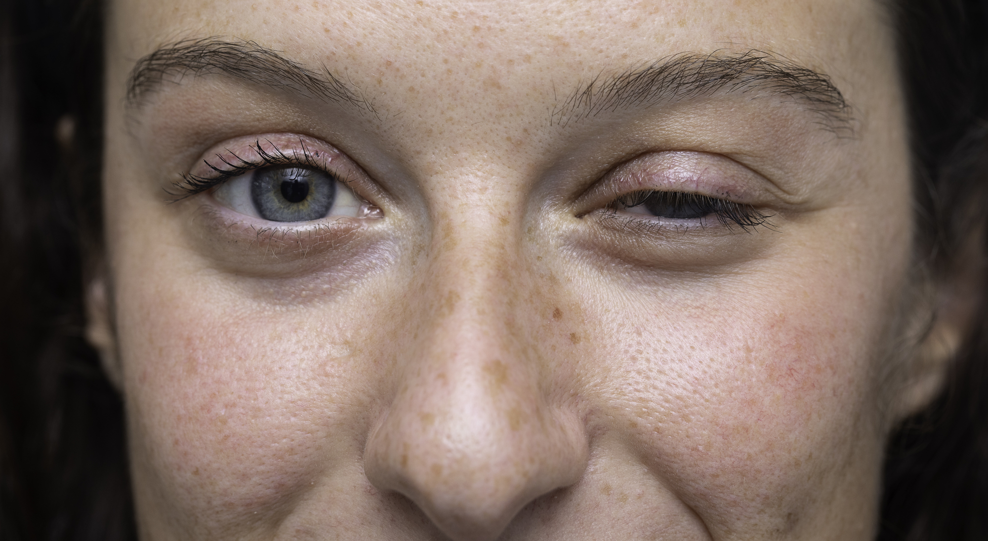 ögon hos person med myasthenia gravis
